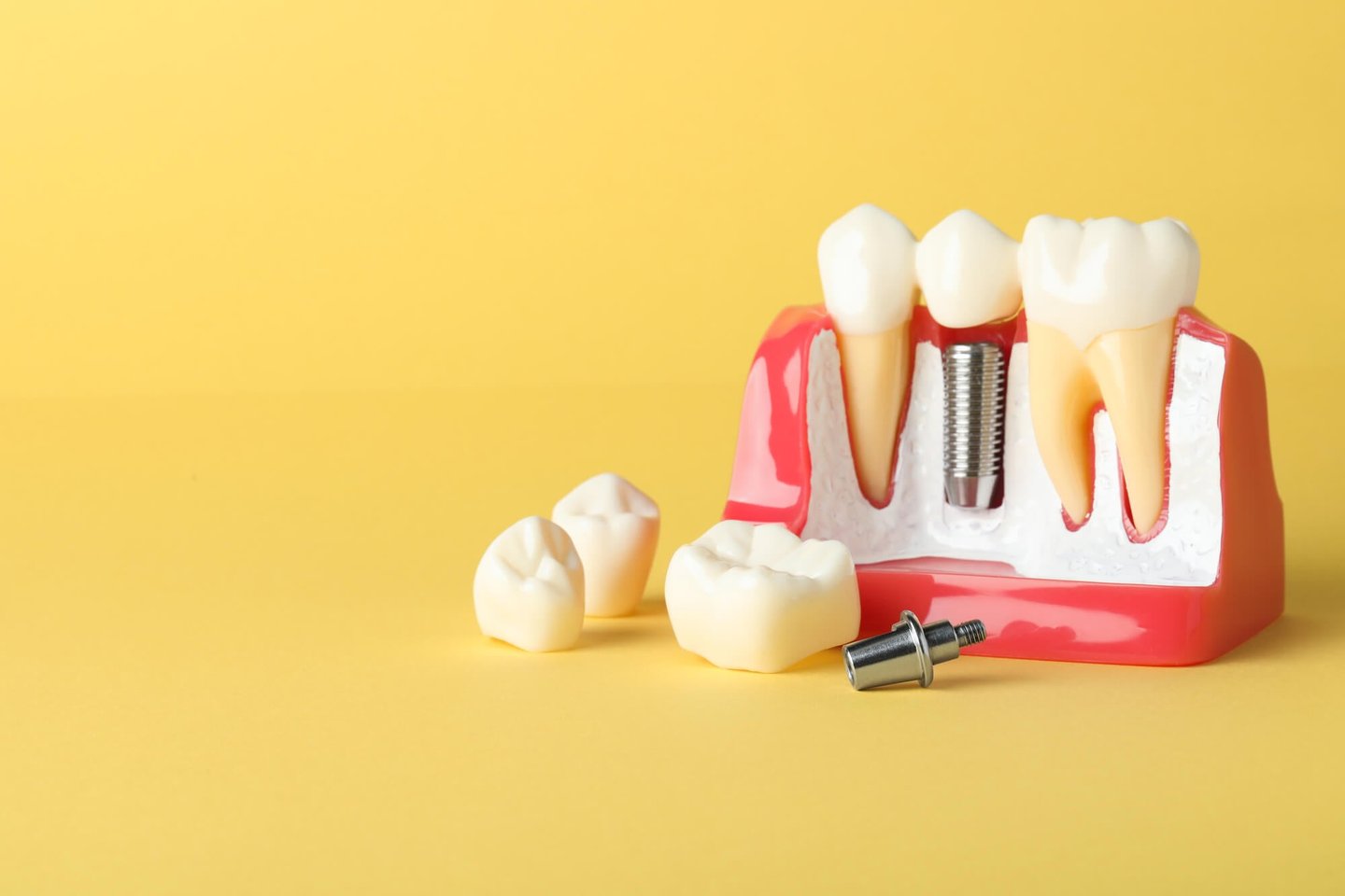 A Natural Look and Feel: Why Dental Implants Are Worth It 