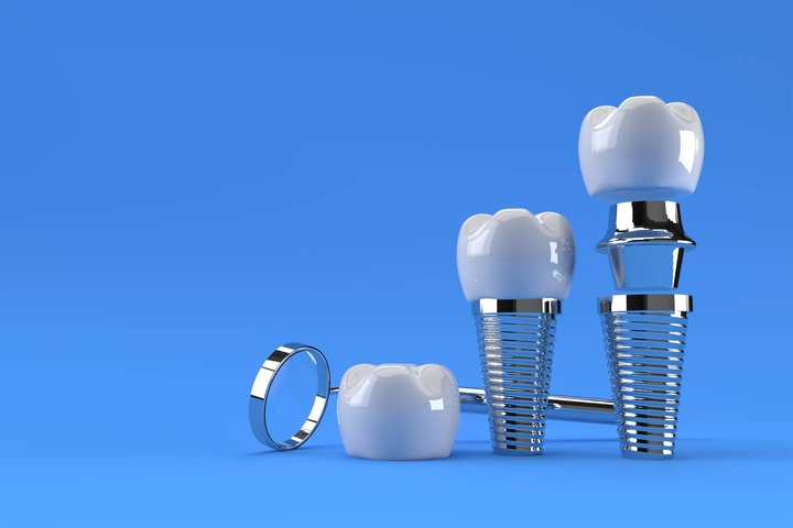 All-on-4® Dental Implants: Are You a Candidate?