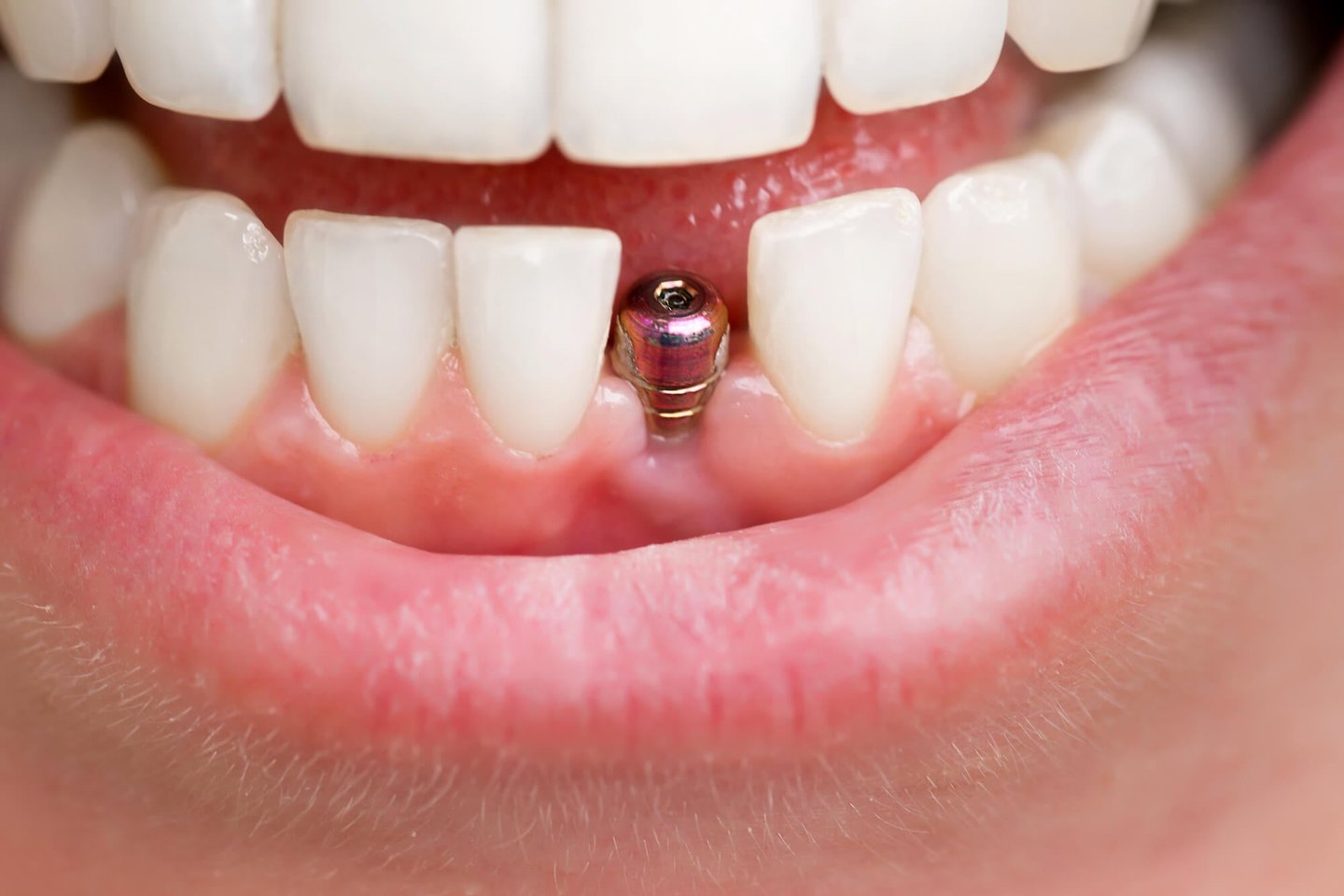 Dental Implants in mouth