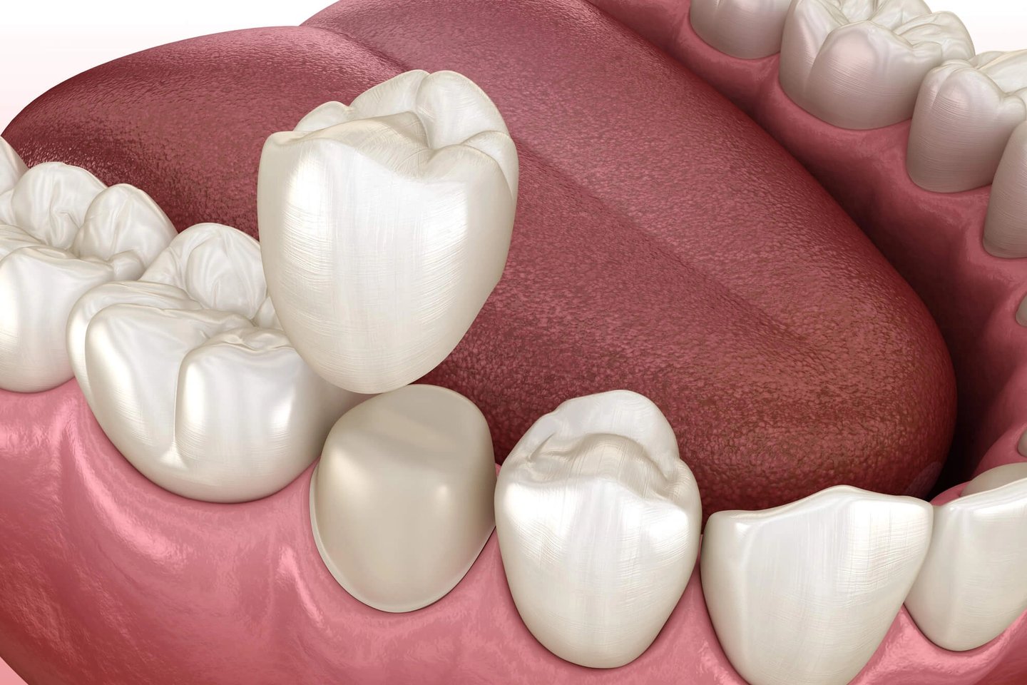 dental crowns orlando fl