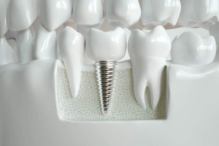 dental implants in Orlando FL between natural teeth
