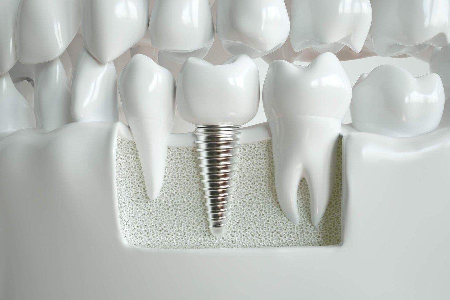dental implants in Orlando FL between natural teeth