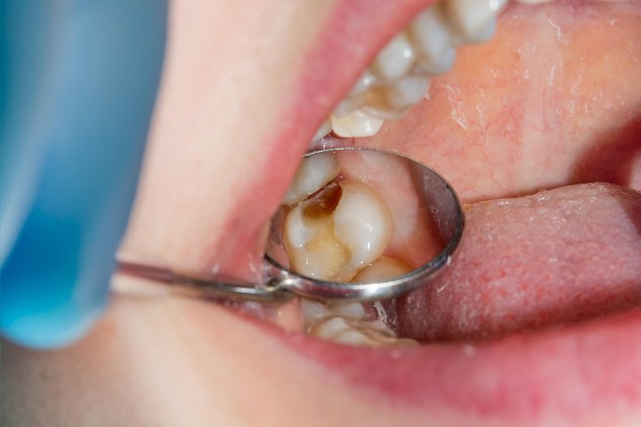 Dentist in winter park examining a tooth with a cavity