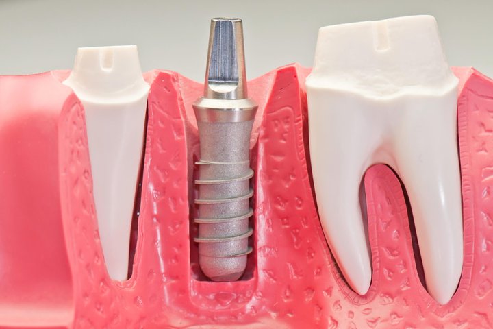 Model of dental implants in orlando fl