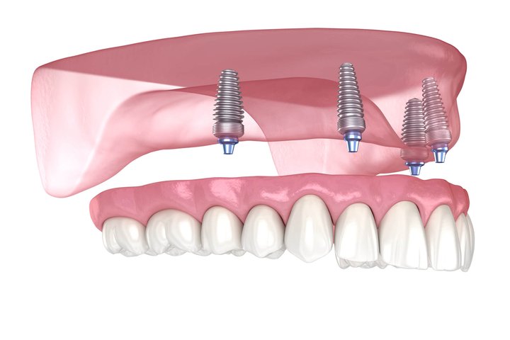 3D all-on-4 dental implants Winter Park fl