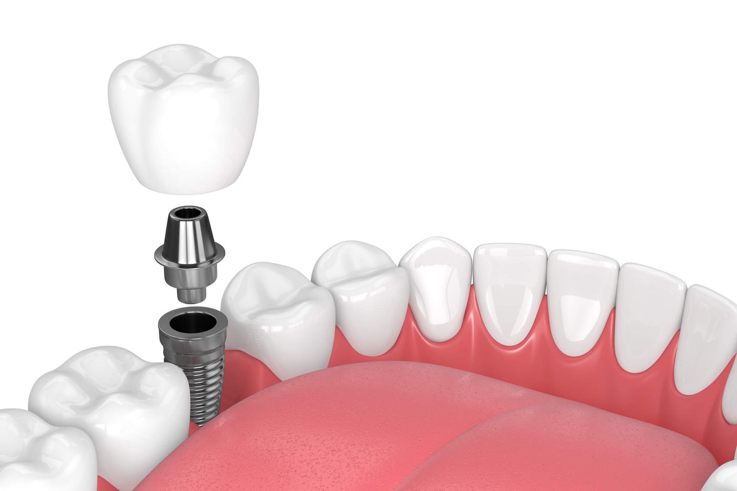 computerized illustration of dental implants