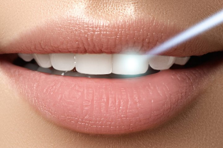 Essential Things to Know About Porcelain Veneers