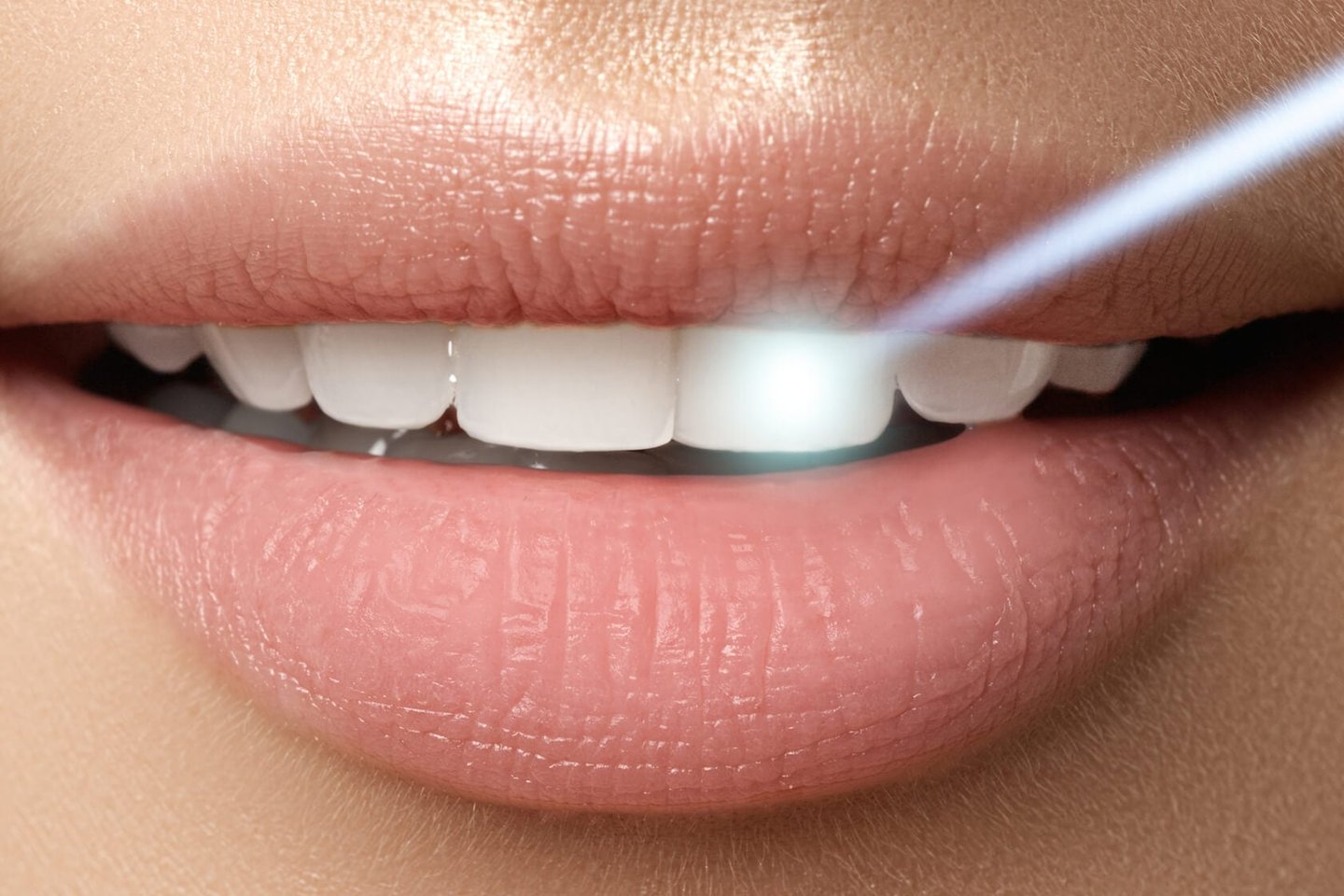 Essential Things to Know About Porcelain Veneers