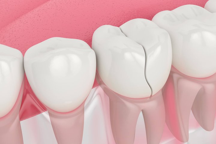 3D render of damaged dental crowns winter park