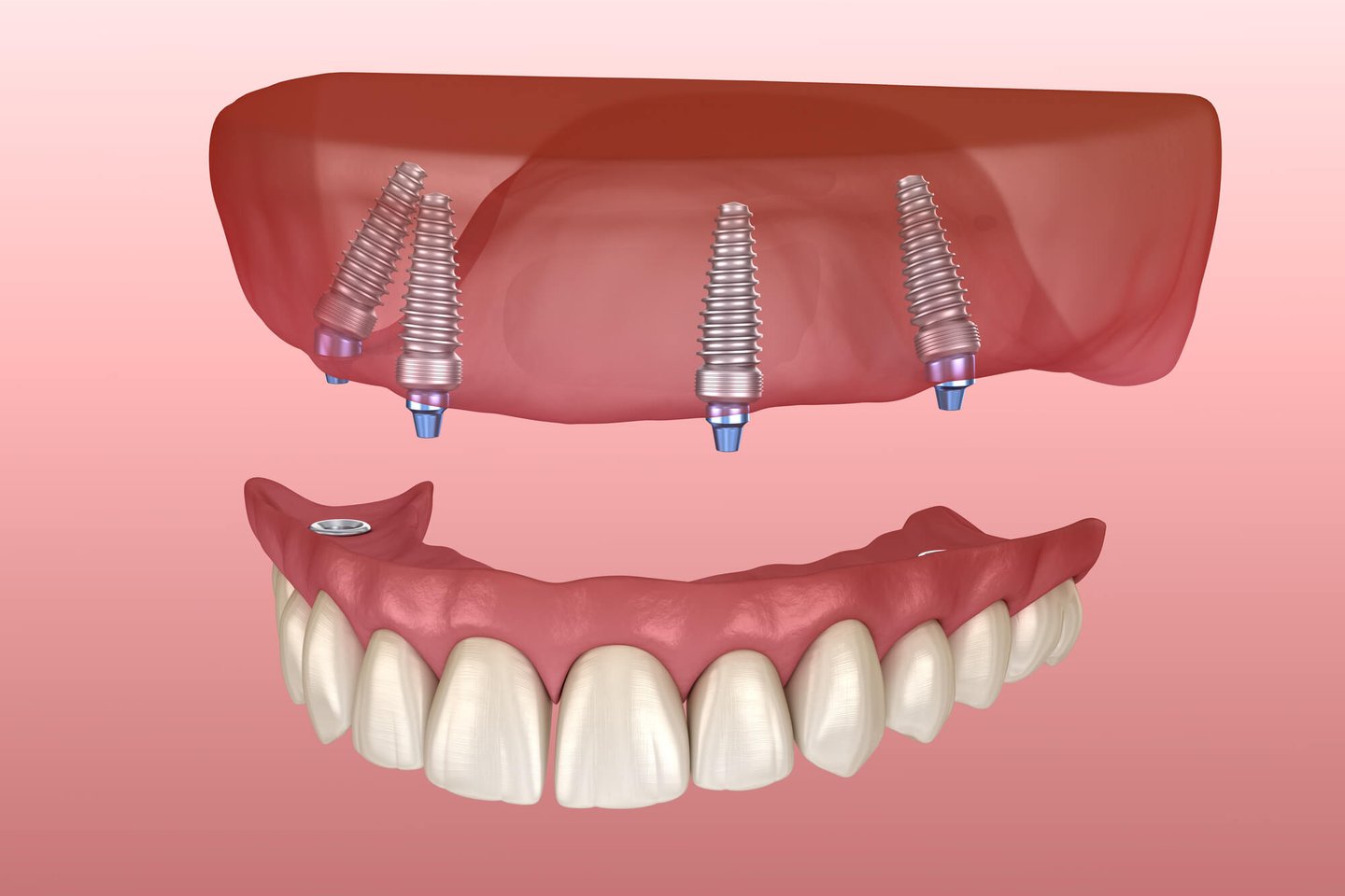 3D-image-of-All-on-Four