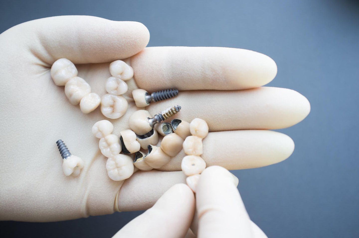 all-on-4 dental implants Winter Park fl in gloved hands