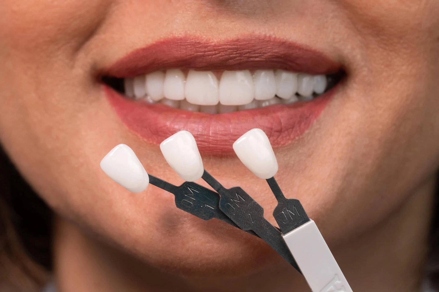 Porcelain Veneers in Orlando FL