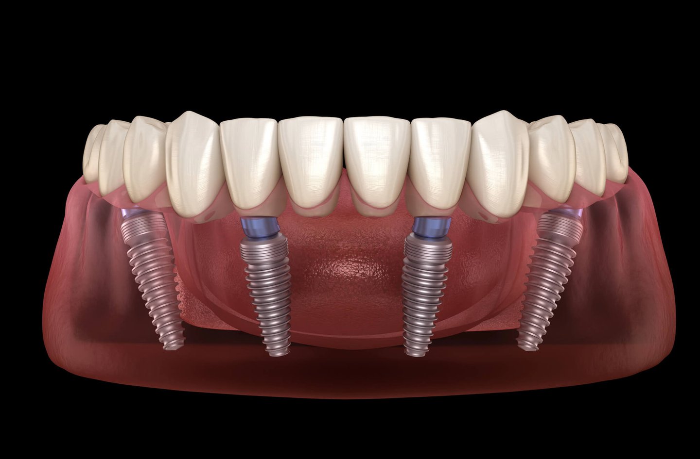 Illustration of All-on-4® Dental Implants in Winter Park FL