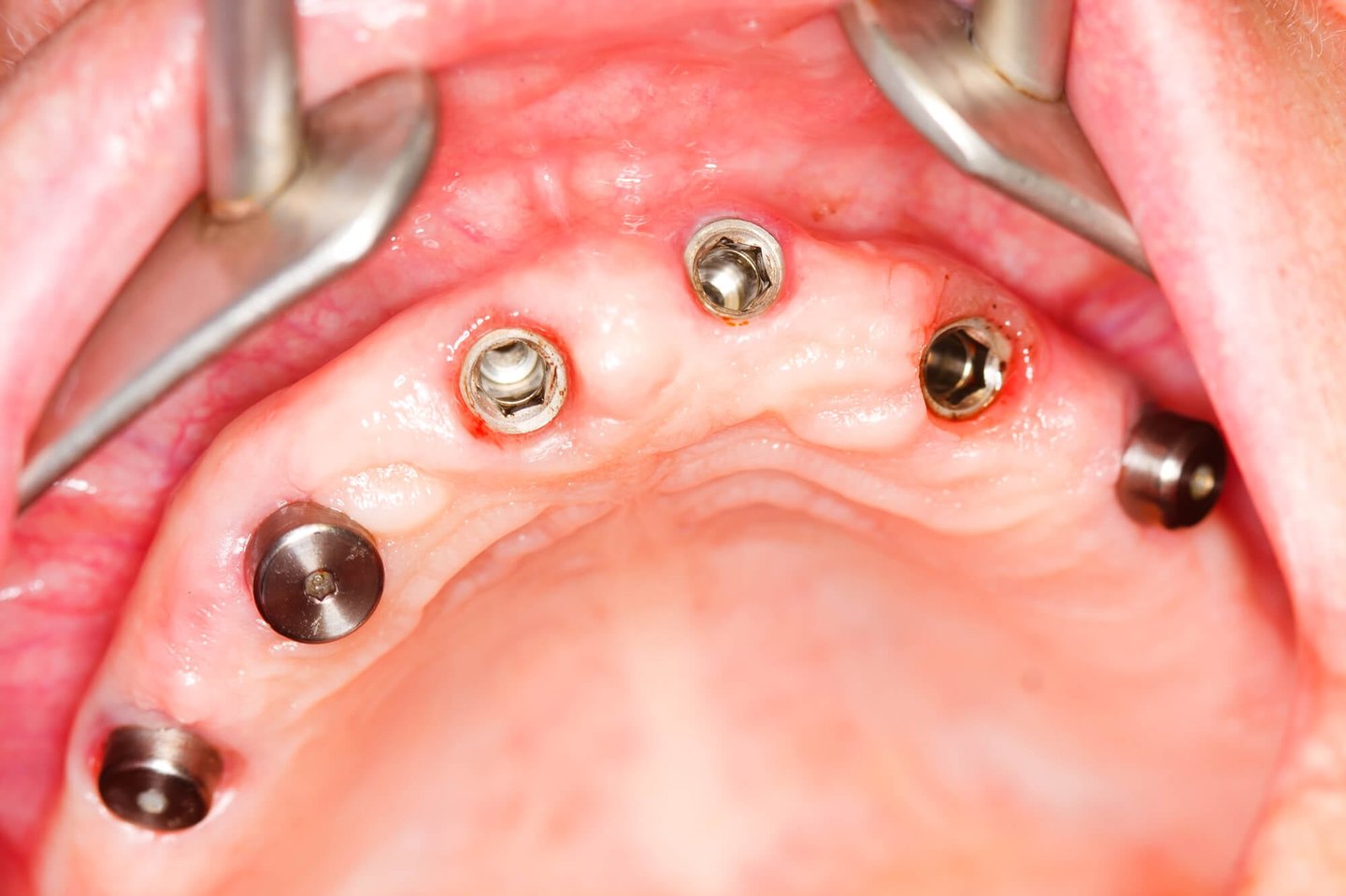Dental Implants in gums