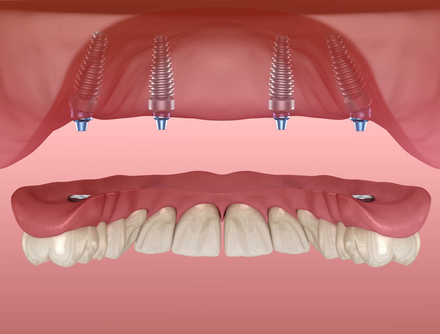 3D image of All-on-Four