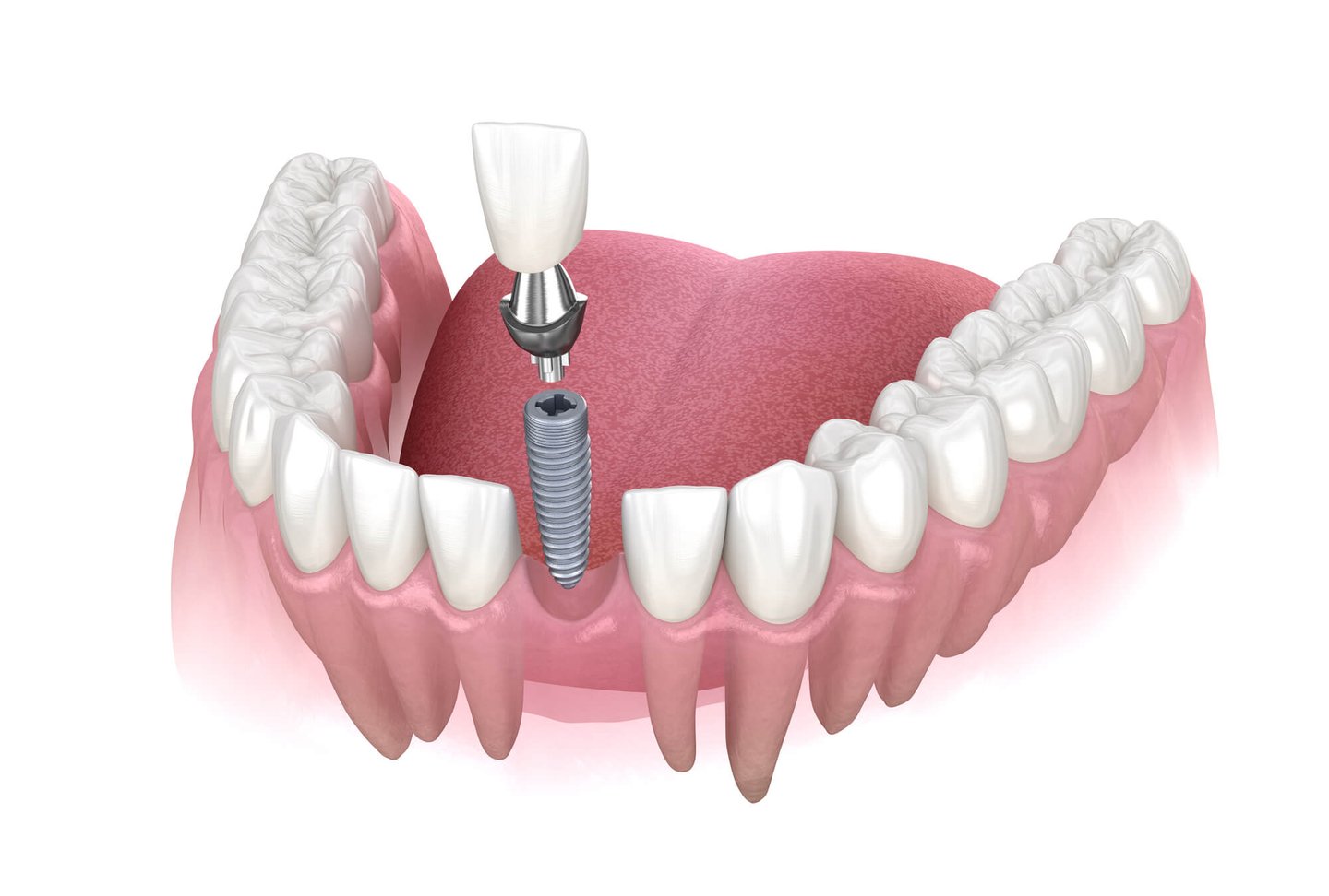 3D image of dental implants in orlando fl