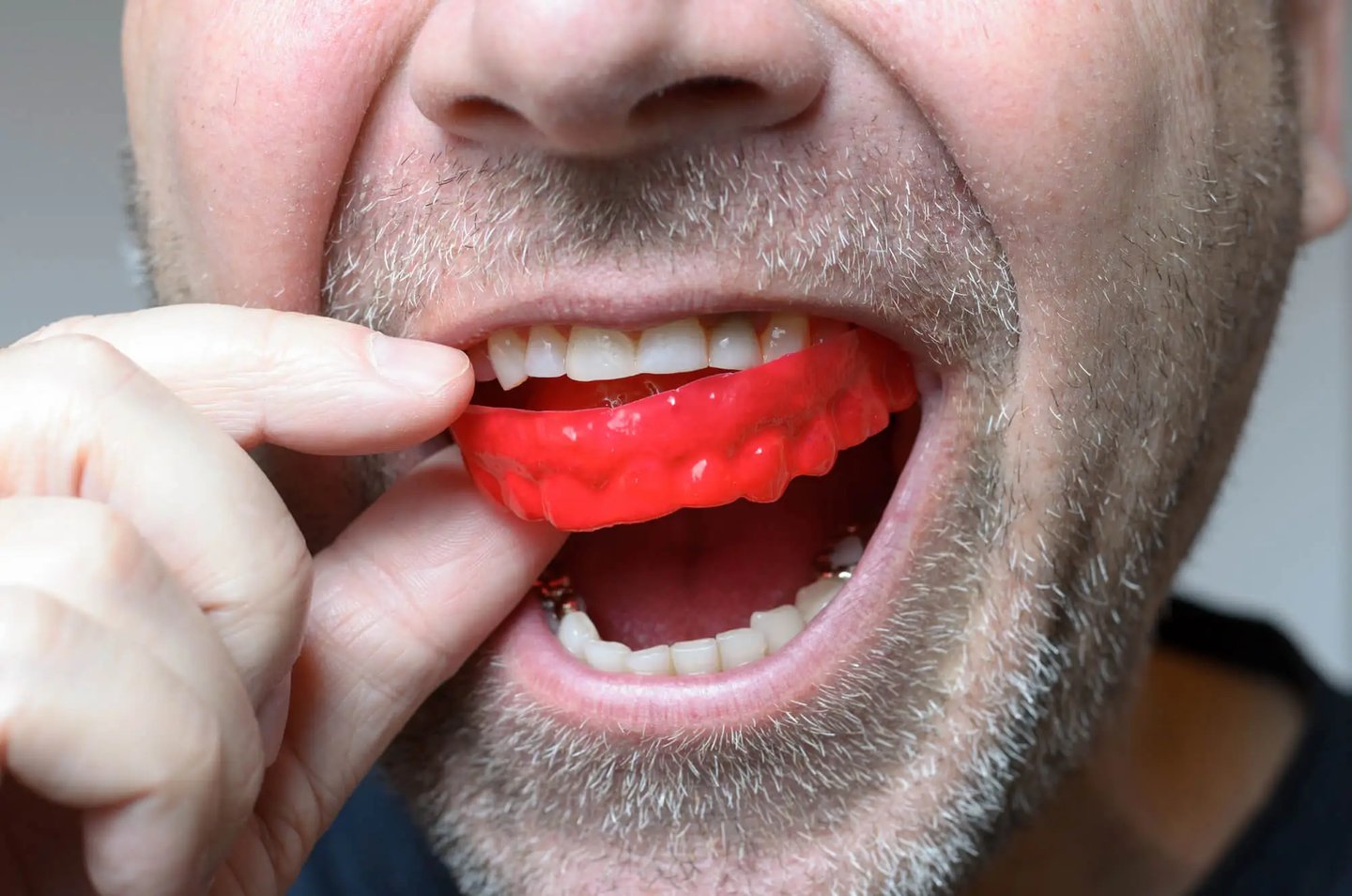 Cosmetic Dentist in Winter Park Explains How to Protect Your Veneers form Bruxism