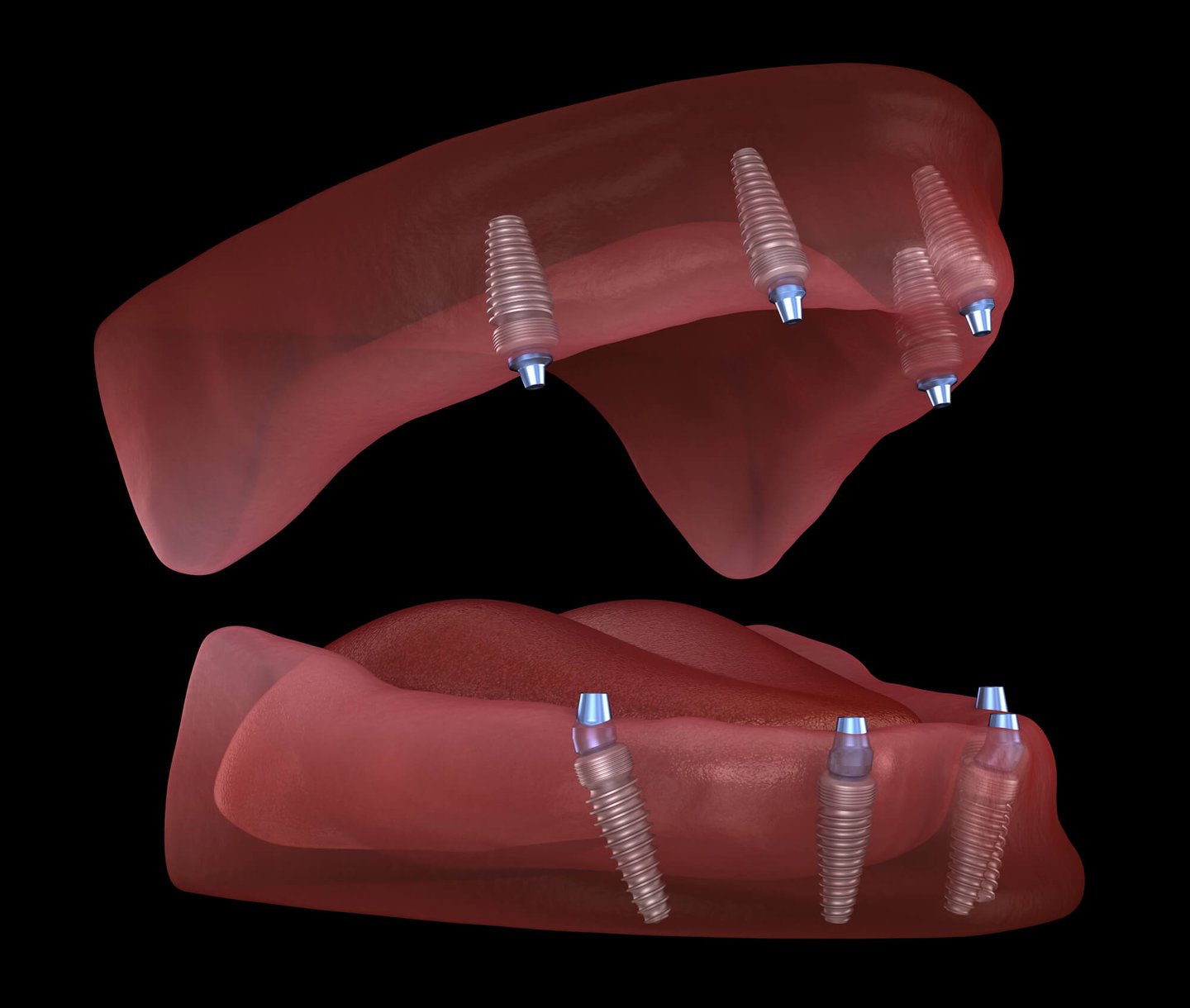 all-on-4 dental implants Winter Park fl