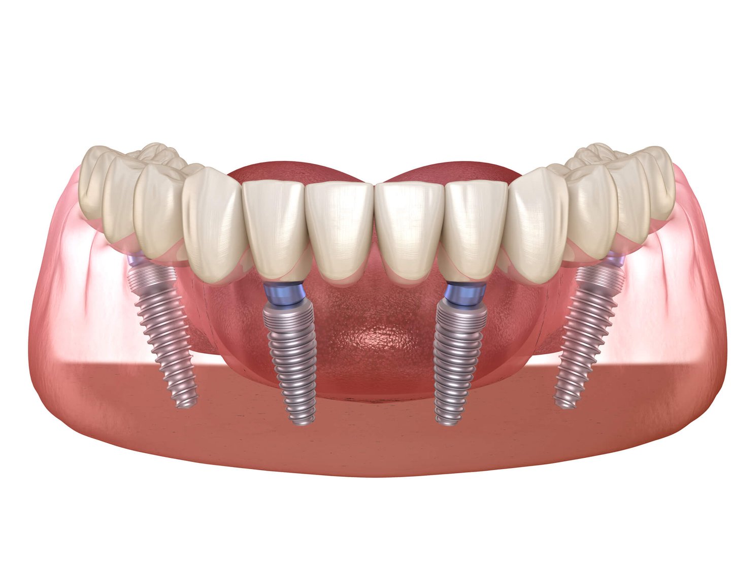 all on 4 dental implants illustration