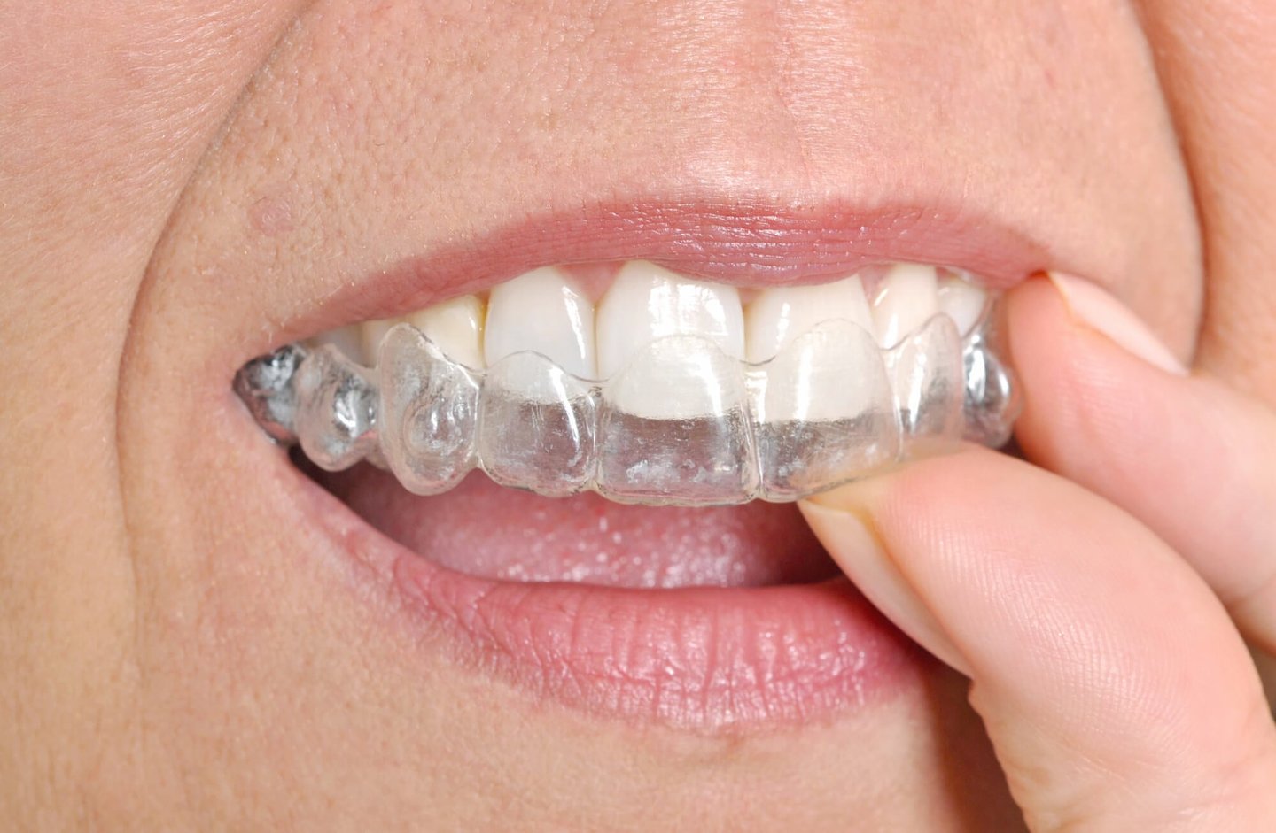 woman wears Invisalign in Winter Park