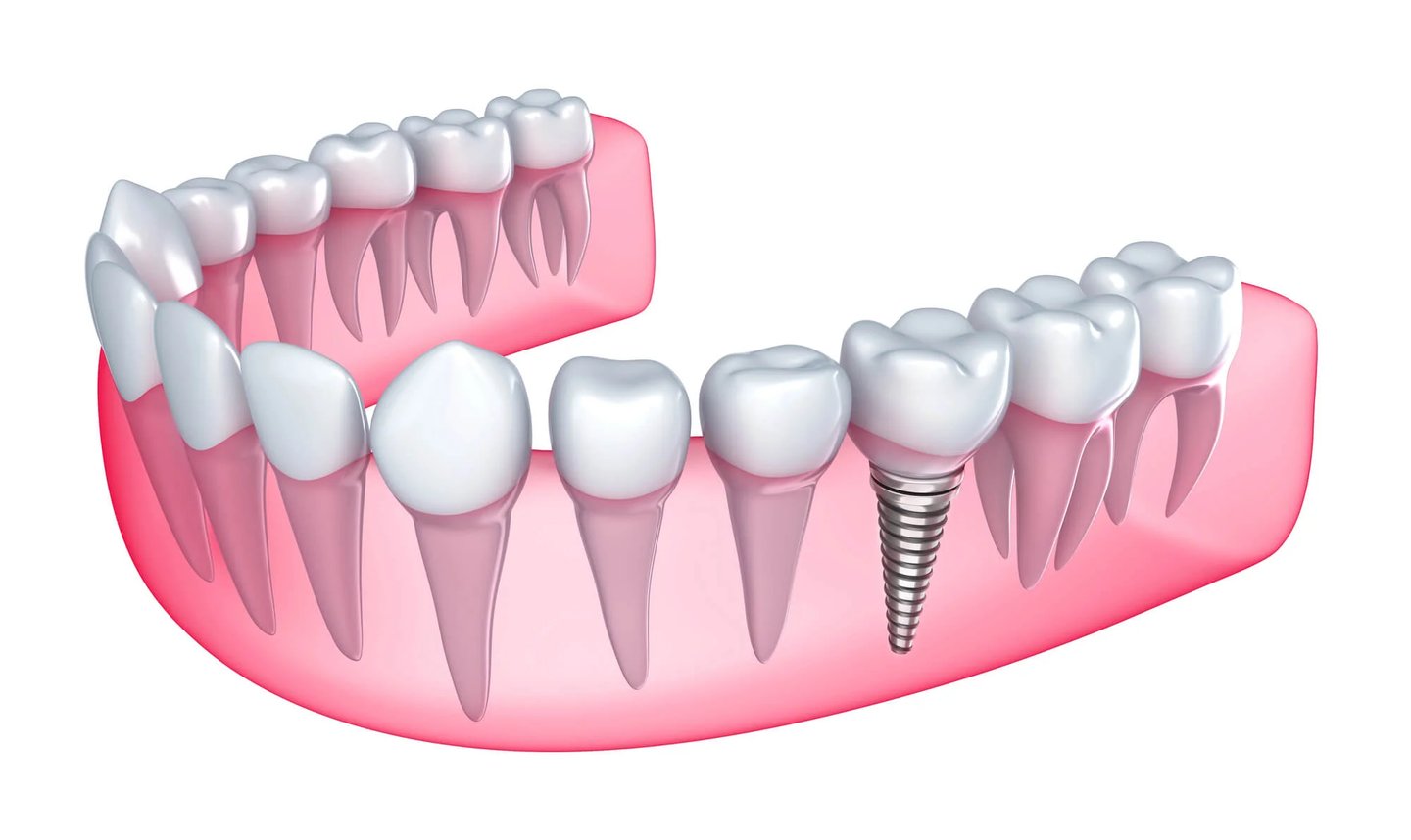 Dental implant replacing missing tooth illustration dental implants in Winter Park, FL