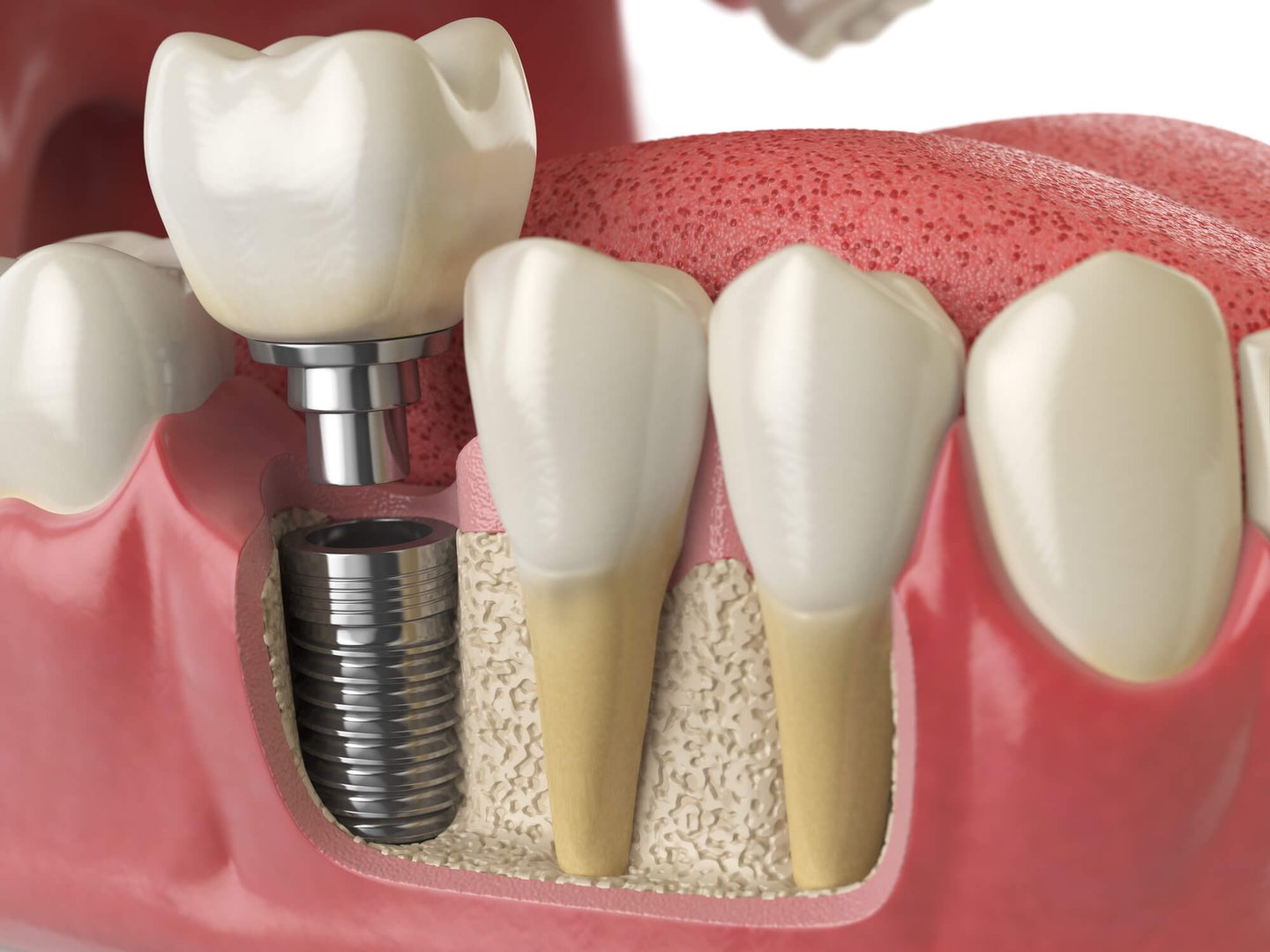 illustration of dental implants