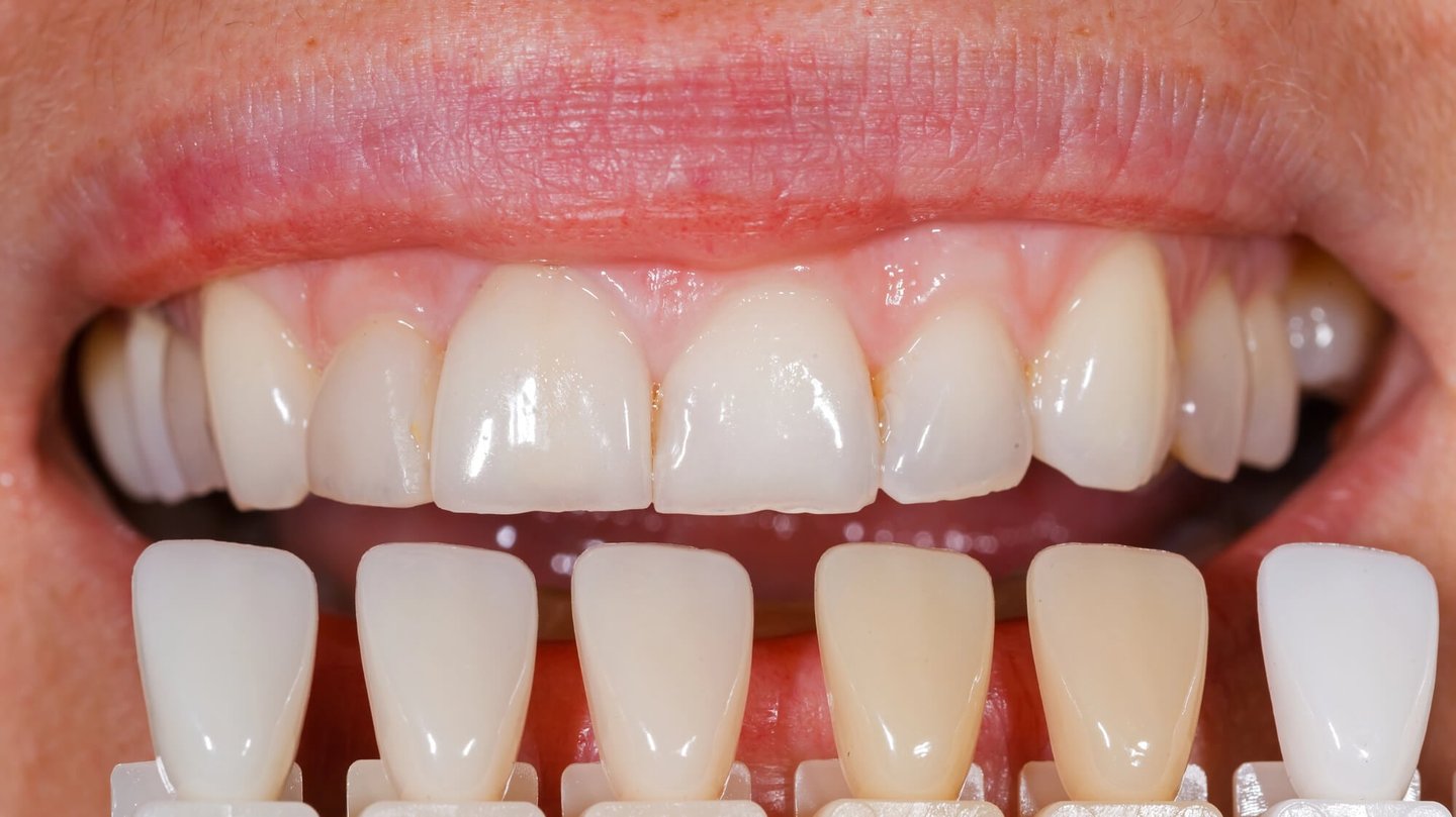 Aftercare Tips for Veneers in Winter Park