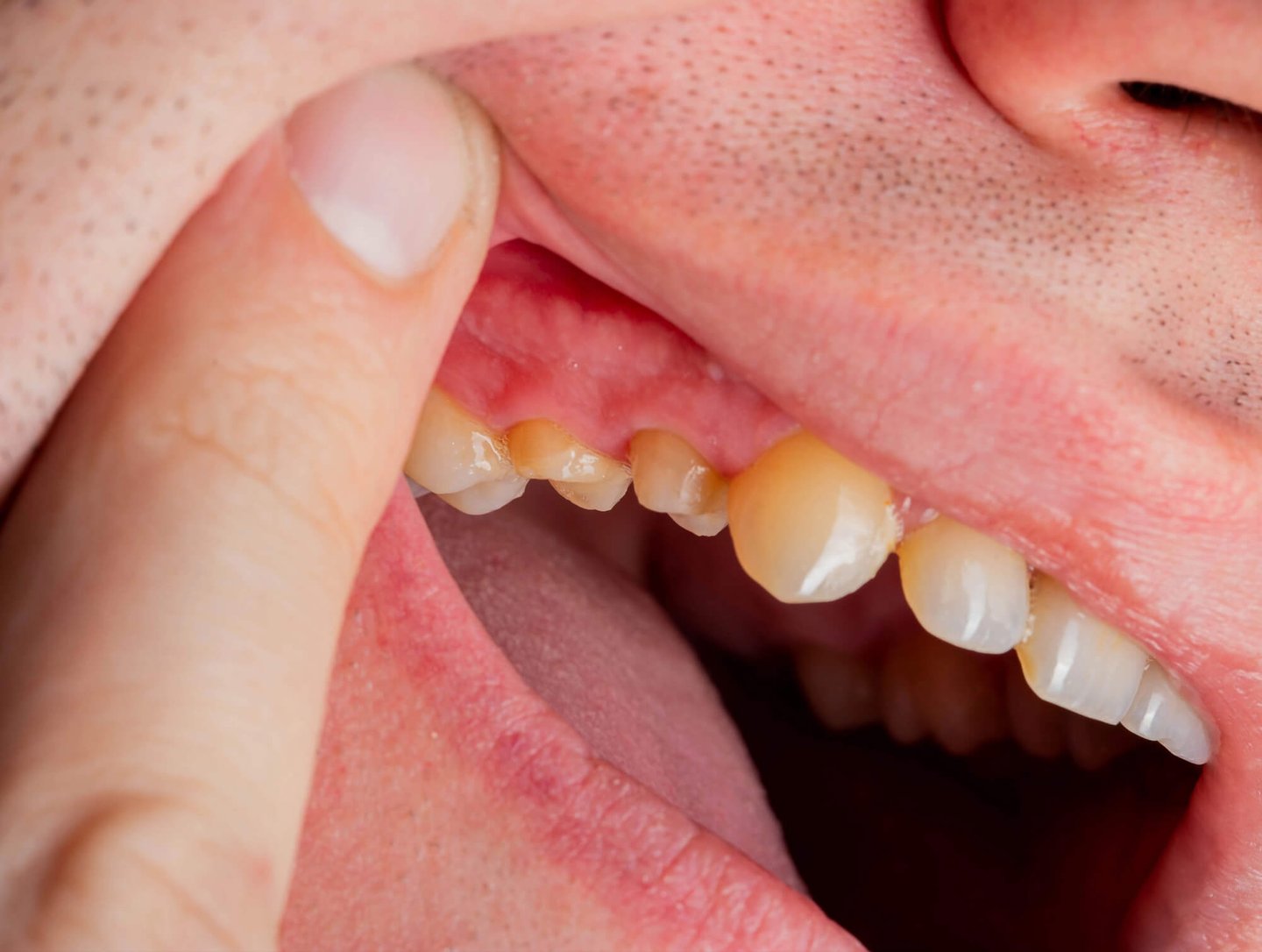 Identify Teeth Grinding with a Dentist in Winter Park