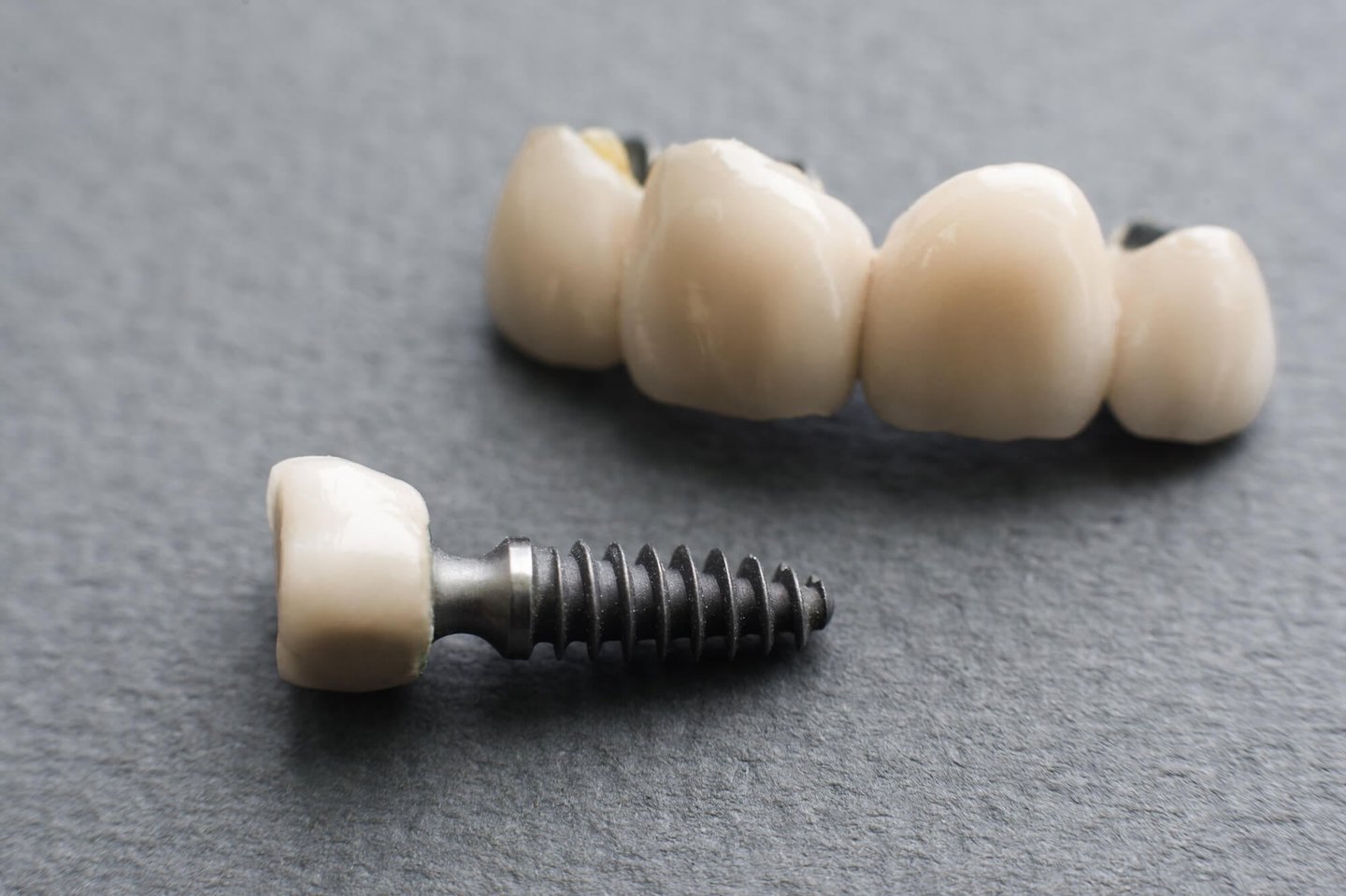 dental implant and bridge for a successful full mouth restoration