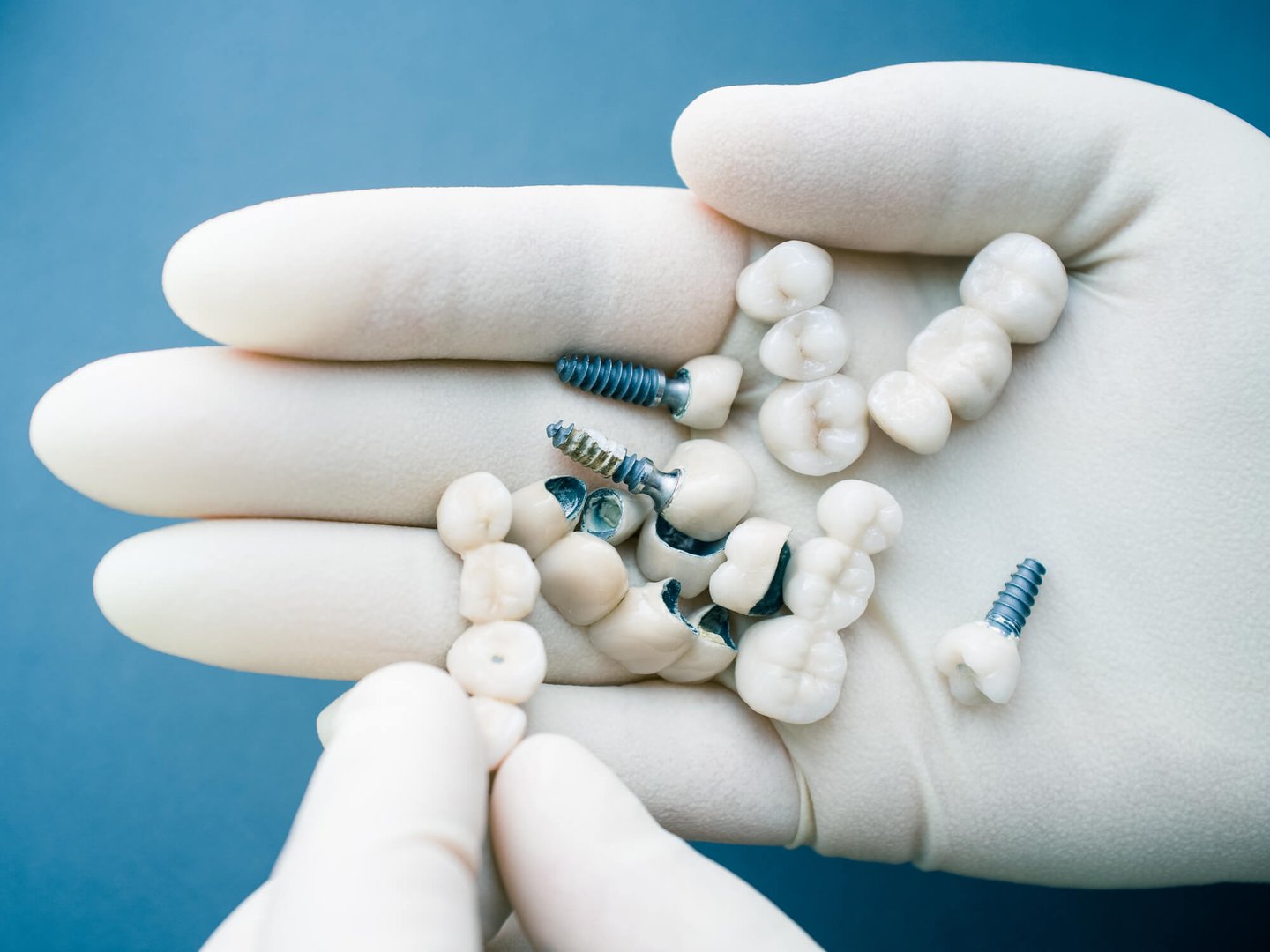 All-On-Four and dental implants