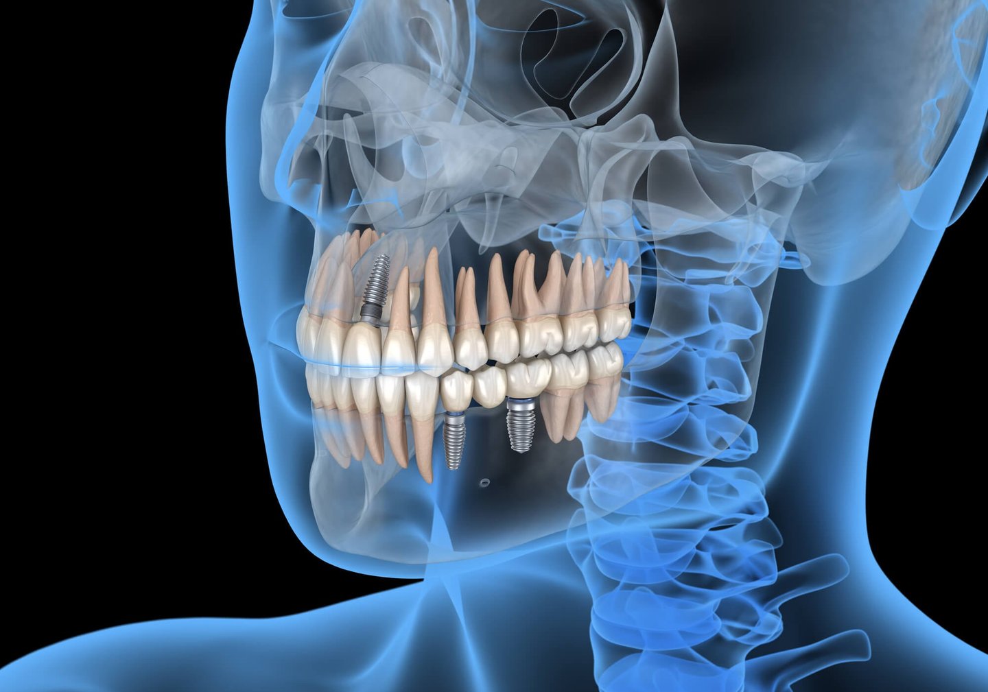 x-ray of teeth with dental implants