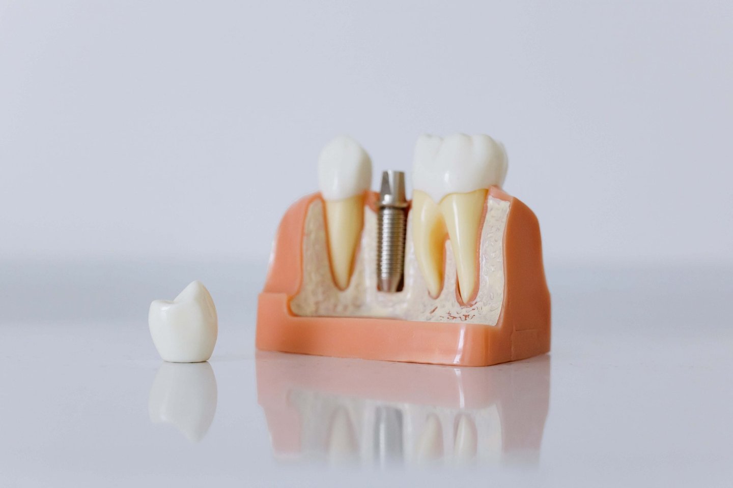 illustration of dental implants