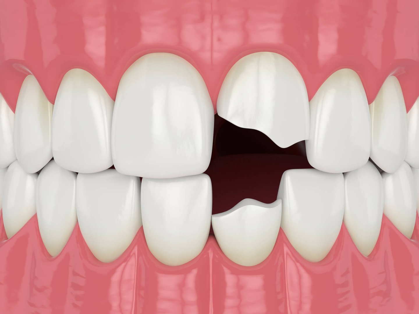 3D-render-of-broken-dental-crowns-winter-park