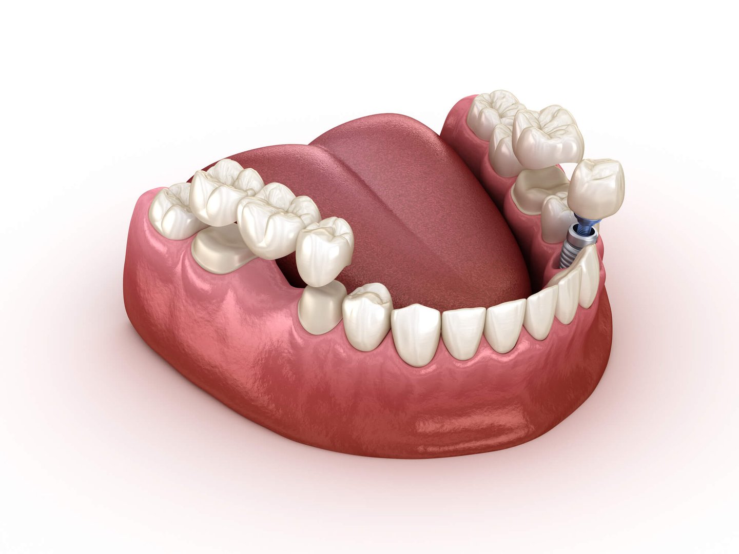 a Full Mouth Restoration with implants and bridgework