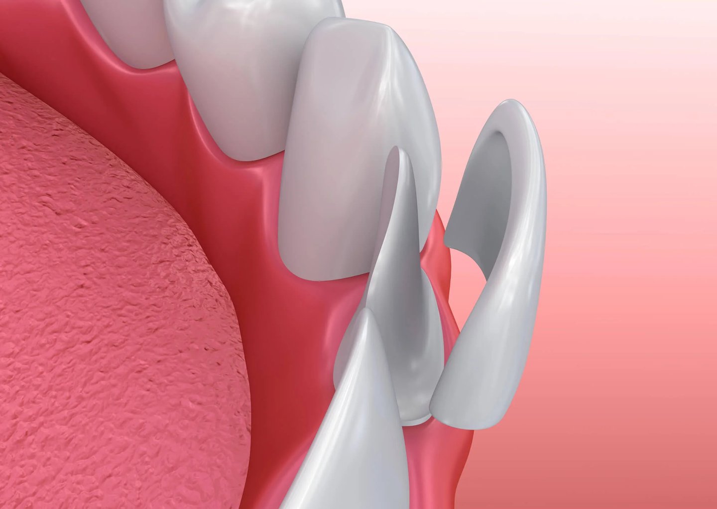 3D illustration of veneer fitting, veneers in Winter Park