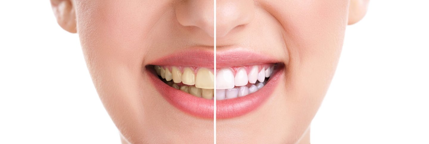 teeth whitening by a best dentist in Orlando, FL