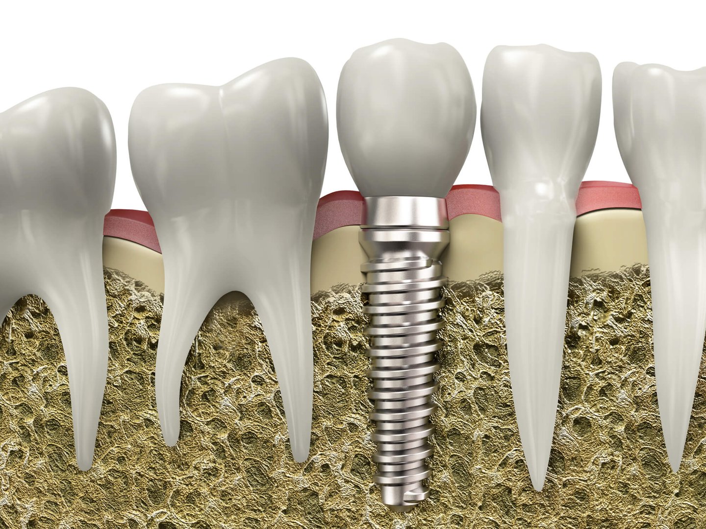 dental implants by a best dentist in Orlando, FL