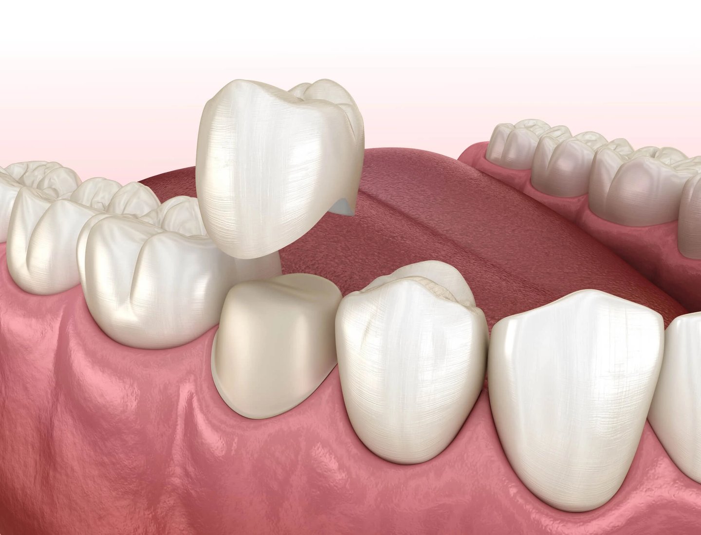 Dental Crowns in Orlando FL