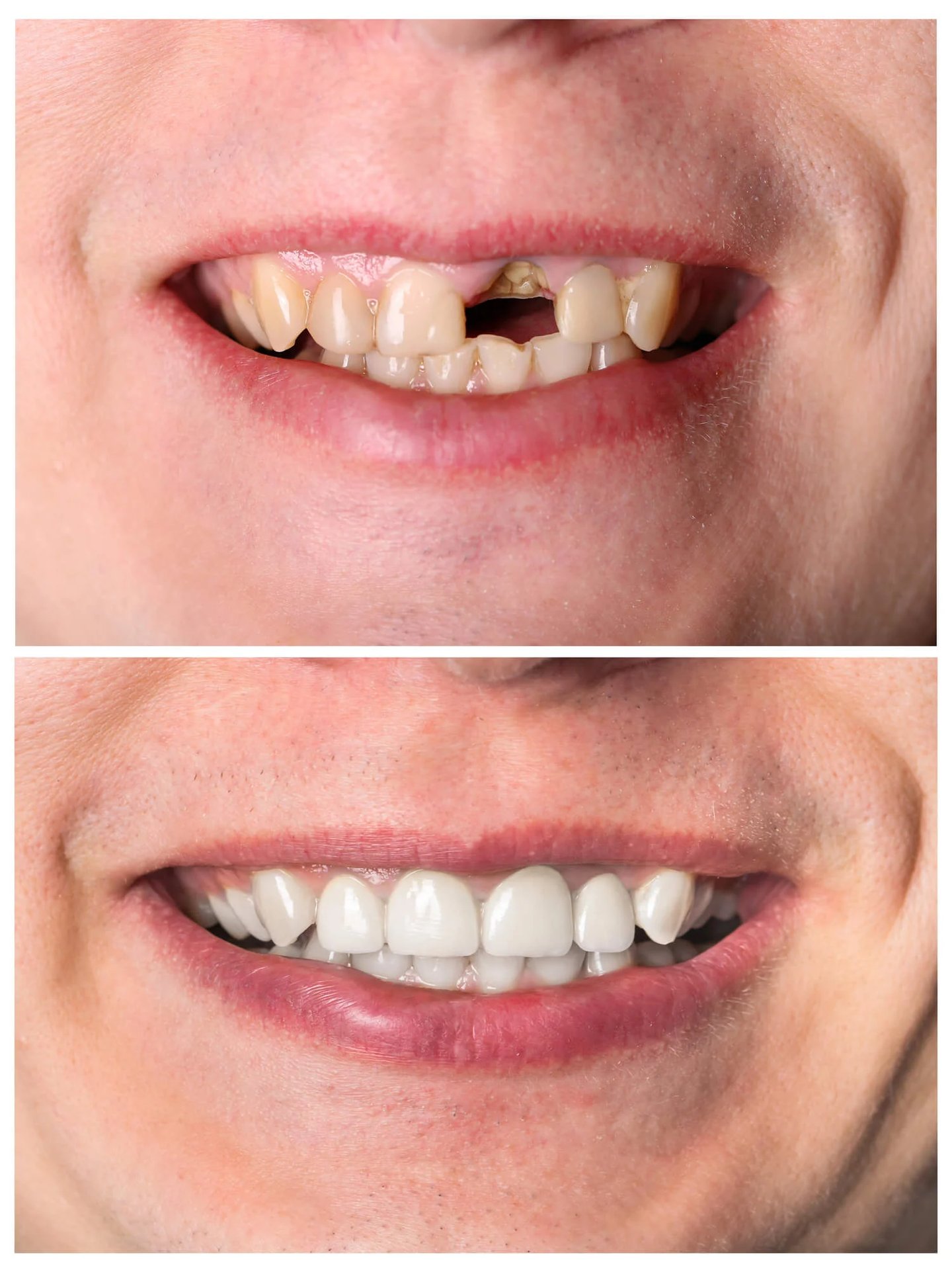 Before and after smile dental crowns Winter Park, FL
