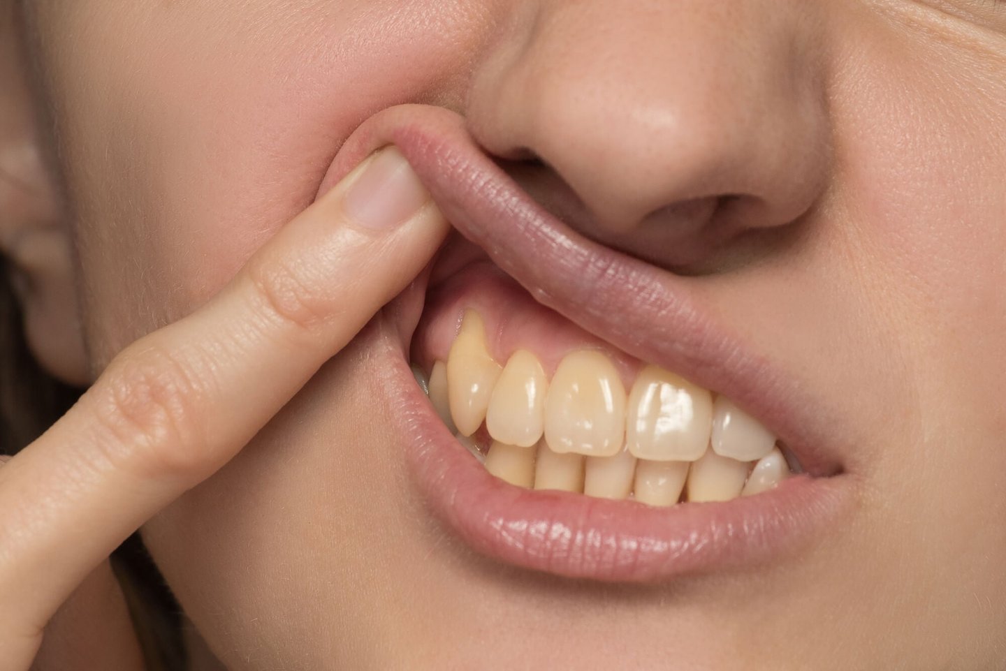 patient with yellow teeth needs park dental teeth whitening