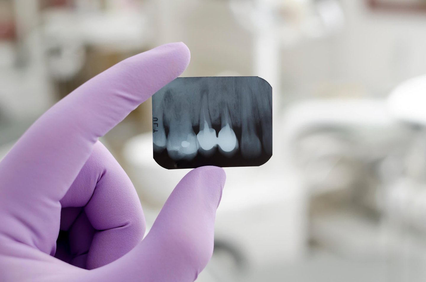x-ray of dental implants in Winter Park, FL