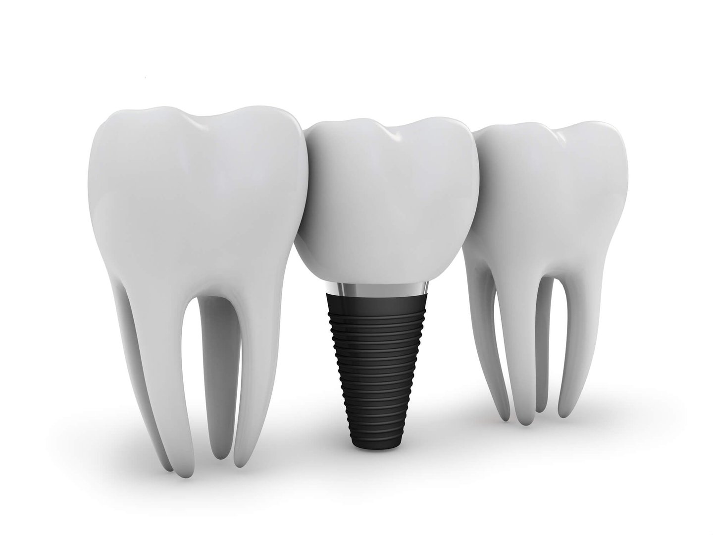 3D illustration of dental implants in Winter Park, FL