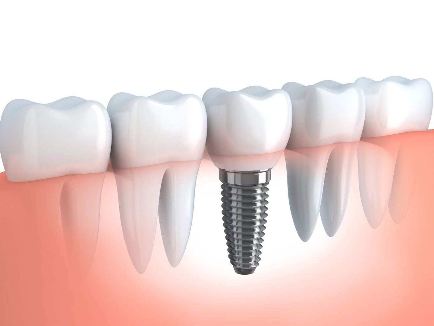 recreation of dental implants inside a mouth in winter park fl
