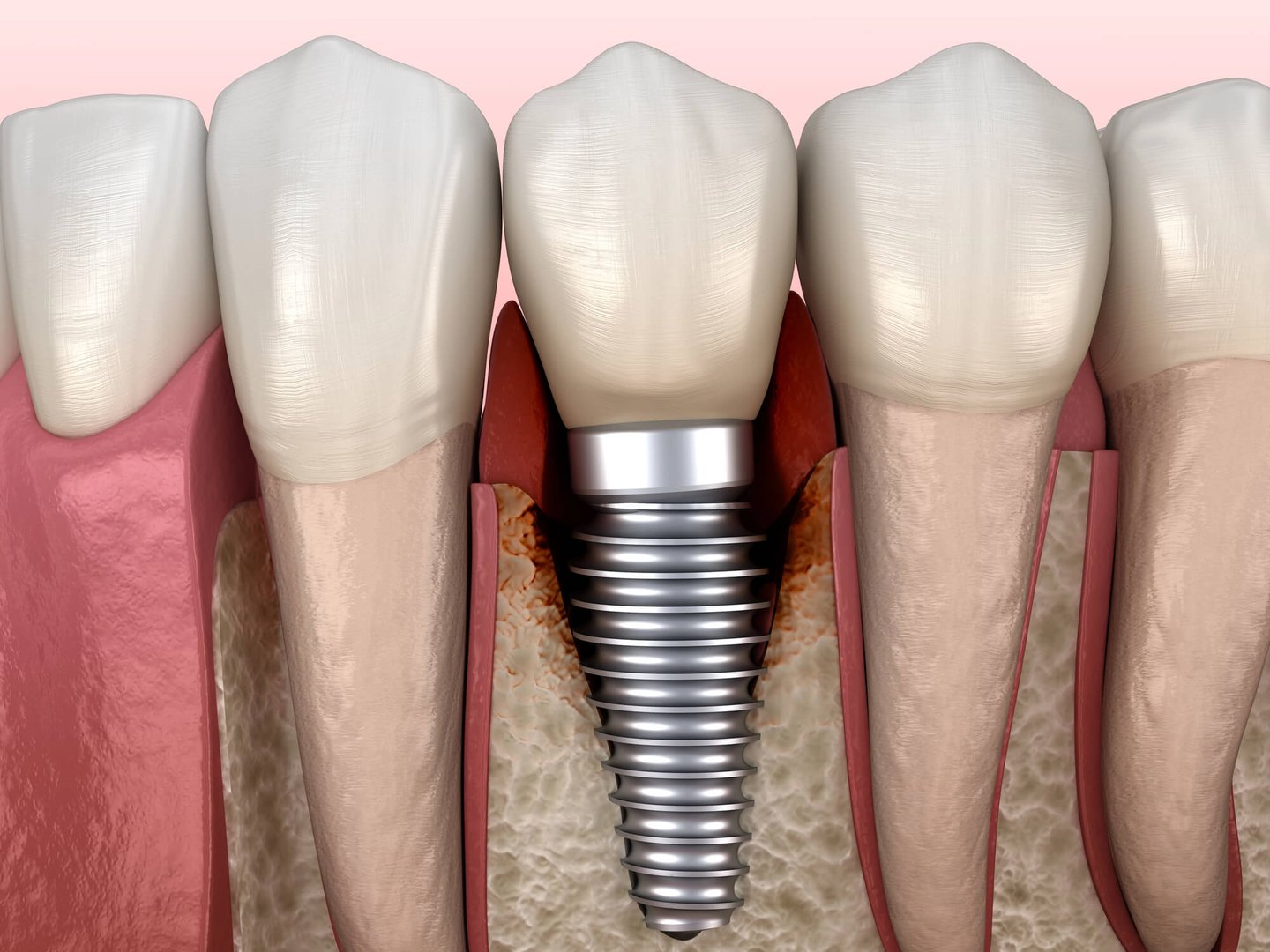 Illustration-of-Infected-Dental-Implants-in-Orlando-FL