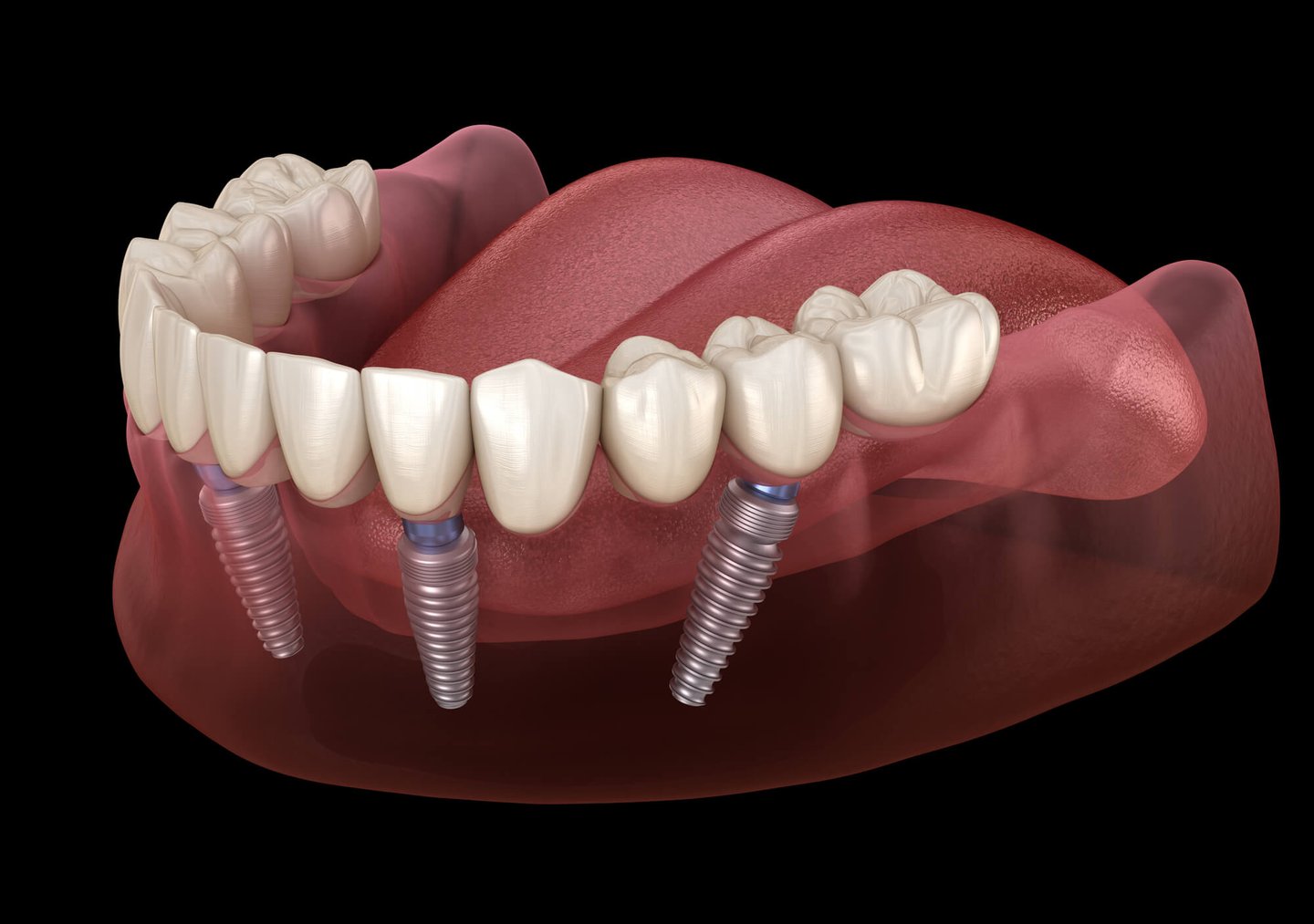 all-on-4 dental implants diagram Winter Park FL