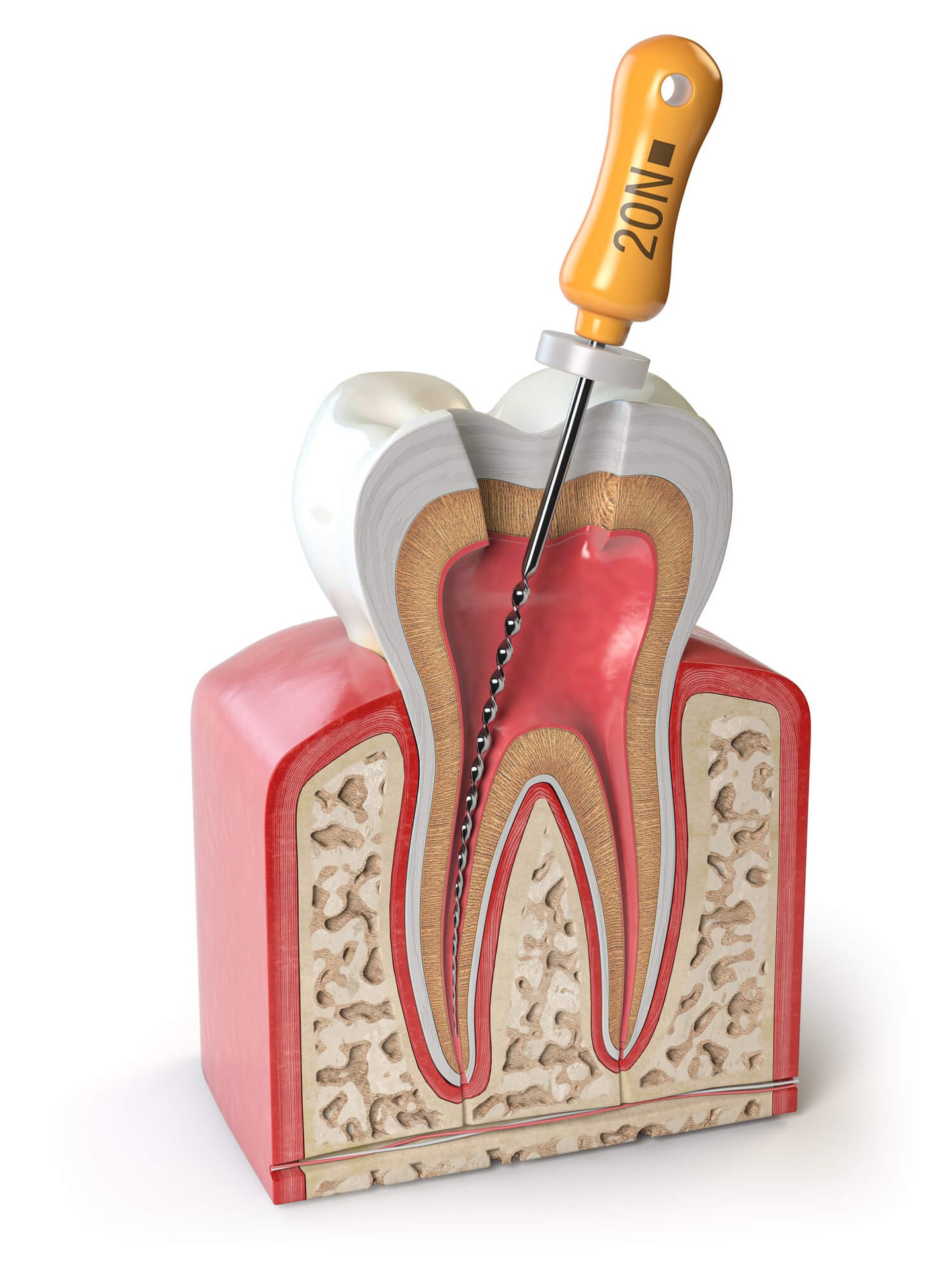 Why Do You Need Dental Crowns in Winter Park After a Root Canal Treatment?
