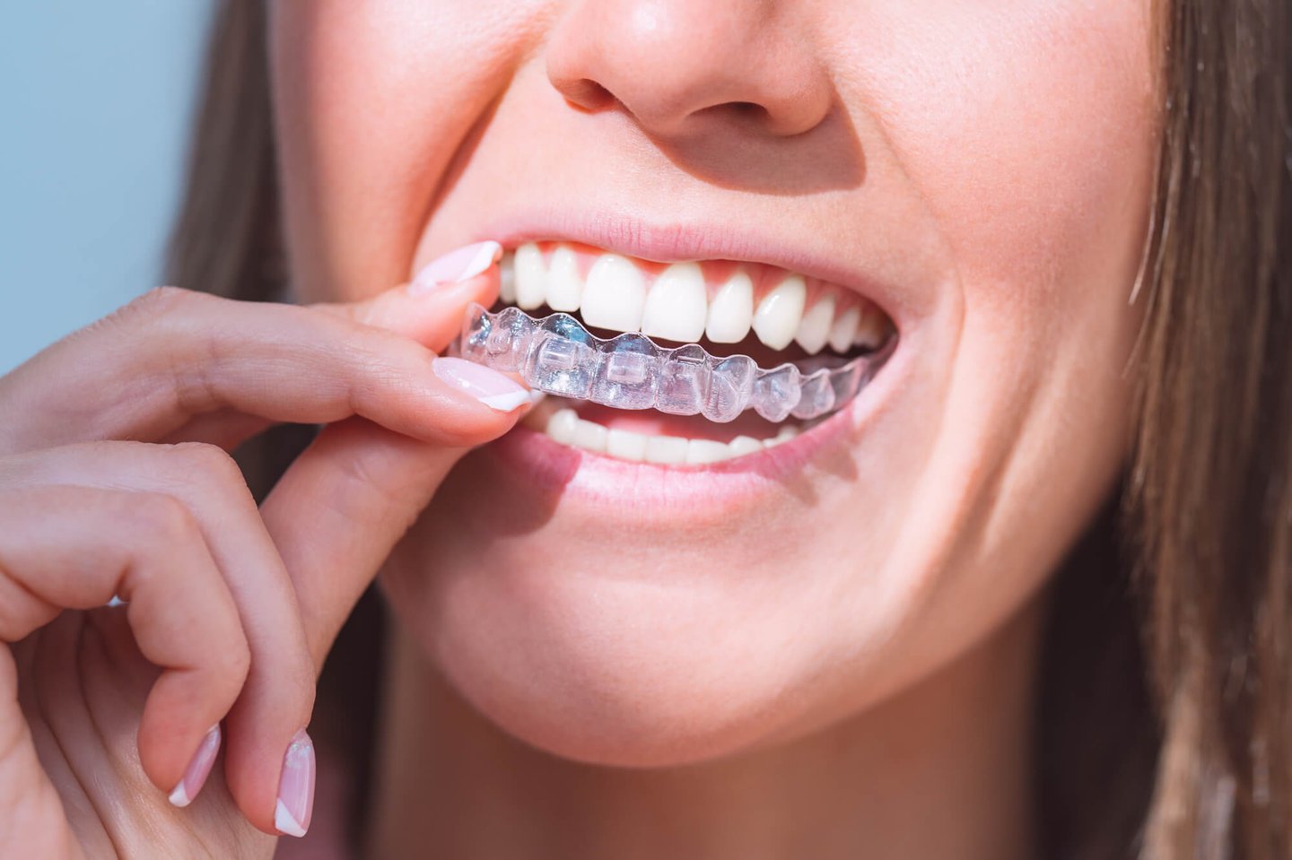 patient about to wear her invisalign winter park
