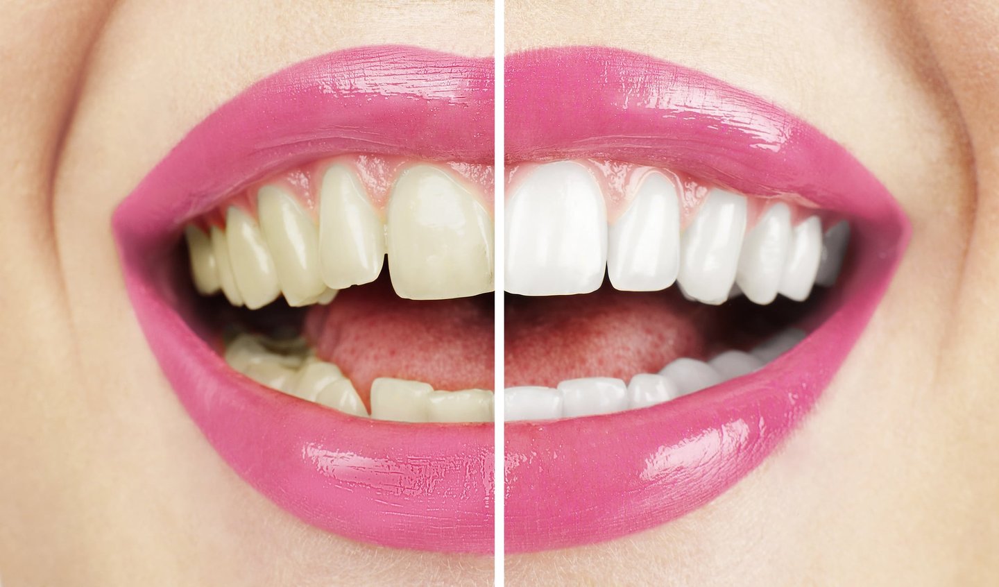 before and after of teeth whitening in winter park