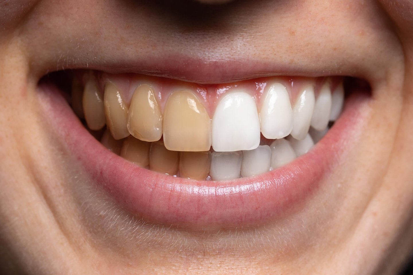cosmetic dentist winter park shows before and after whitening