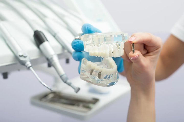 Dental implant teeth model